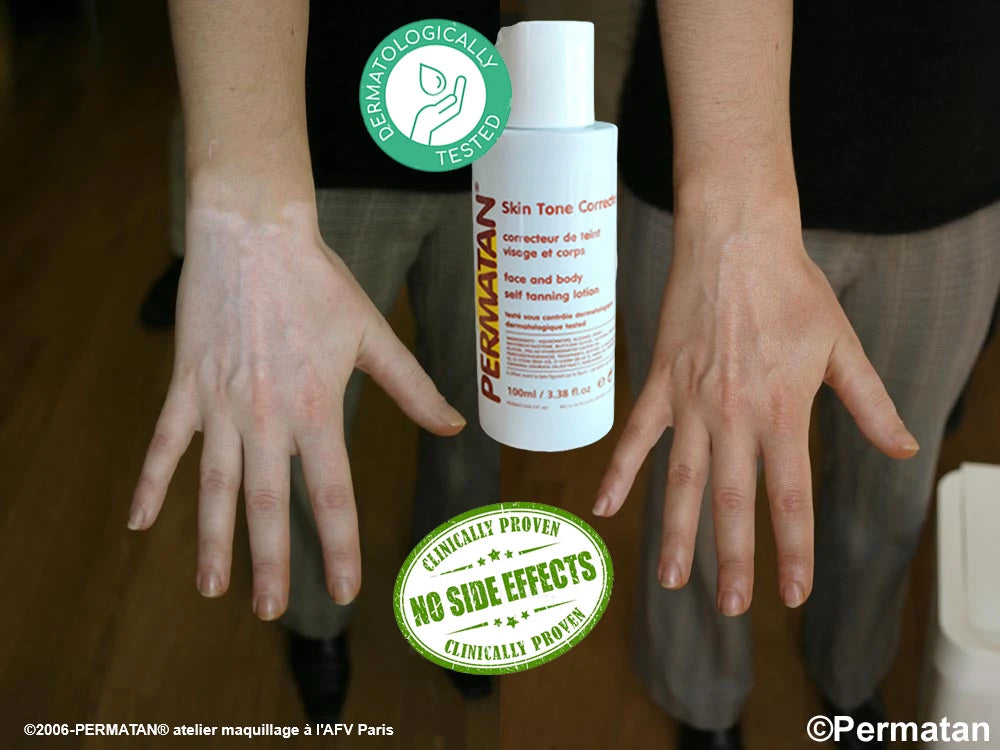 Avant après PERMATAN® sur un vitiligo des mains, photographies authentiques