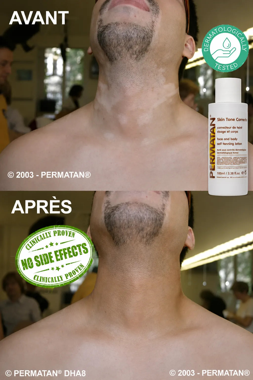 Avant après PERMATAN® sur un vitiligo du cou chez un homme, photographies authentiques de 2003